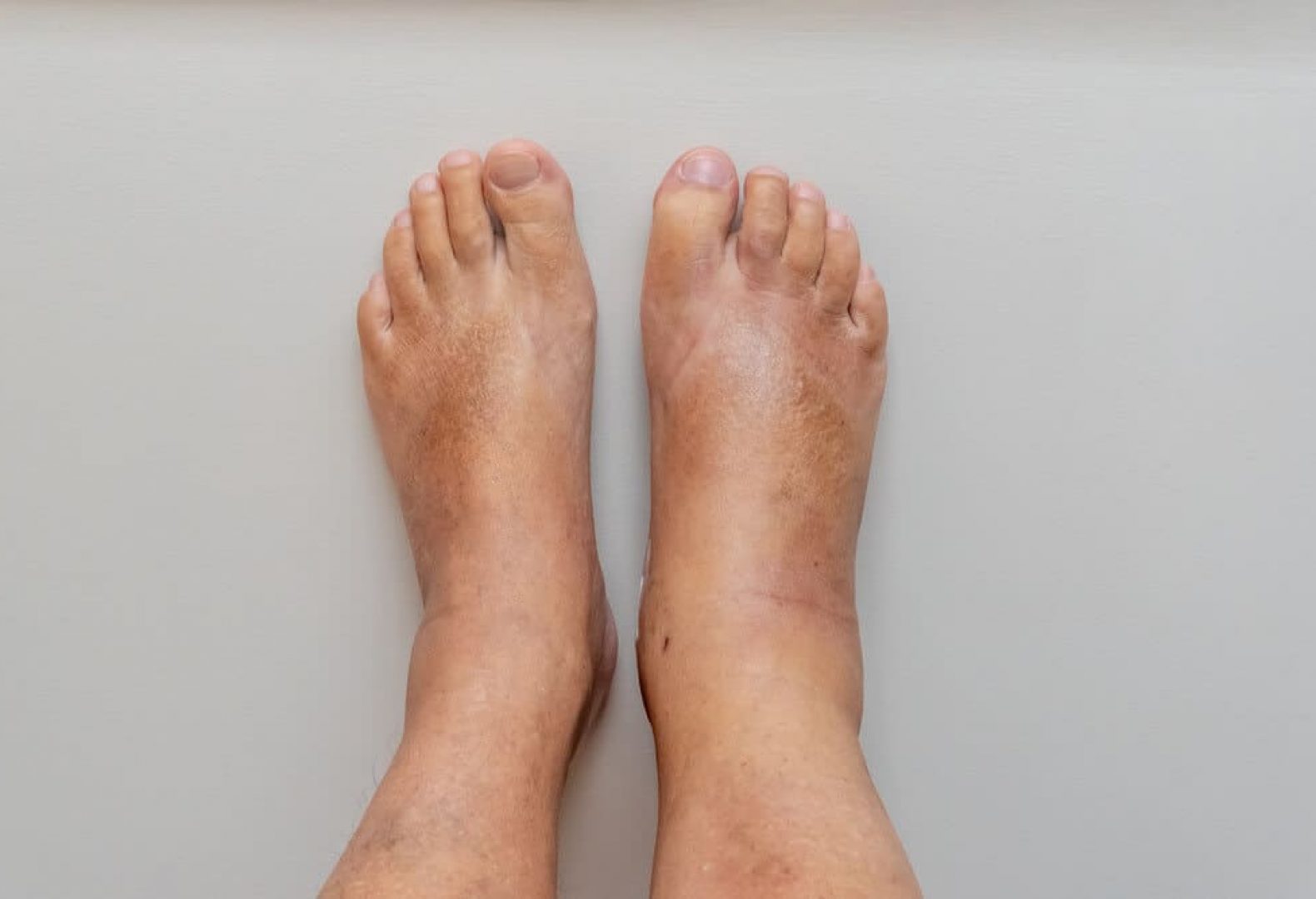 two swollen feet in front of white beige background