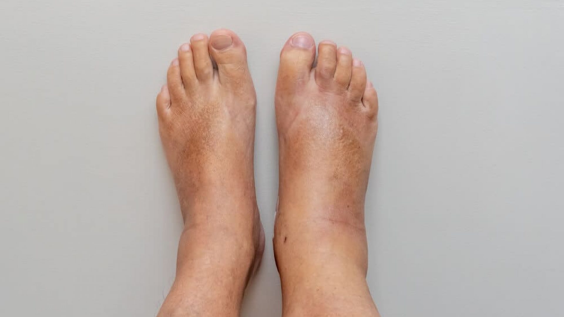 two swollen feet in front of white beige background