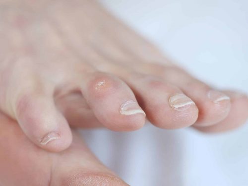 Foot corns 101 causes treatment and prevention Closeup of dry corn on woman toe. Treatment of corns
