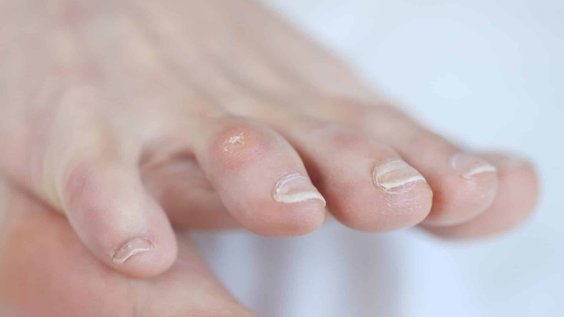 Closeup of dry corn on woman toe. Treatment of corns