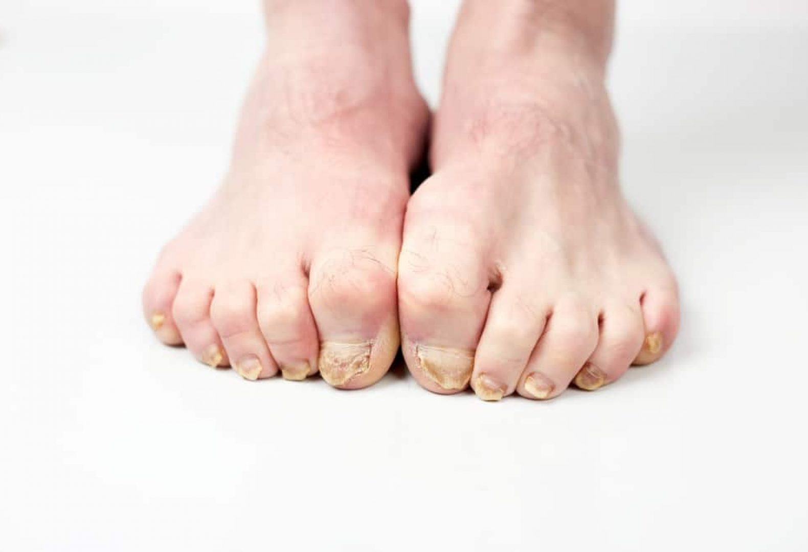 Two feet with fungal infections on toenails on white floor and background