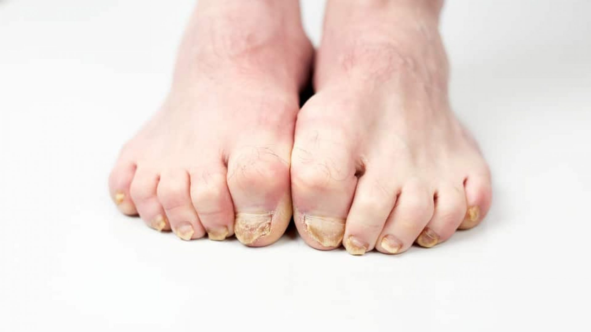 Two feet with fungal infections on toenails on white floor and background