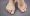 Feet Of Woman Deformed From Rheumatoid Arthritis. Macro