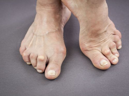 Feet Of Woman Deformed From Rheumatoid Arthritis. Macro