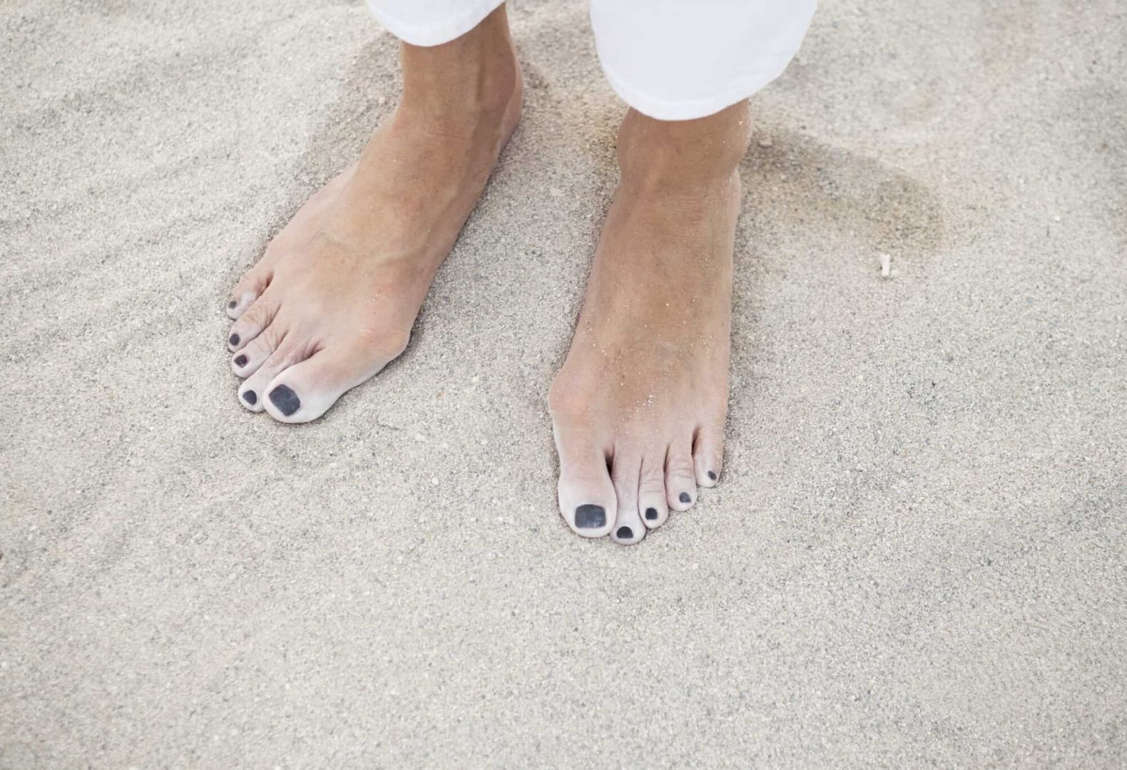 A woman with bunions or crooked big toe is standing barefoot in the sand.