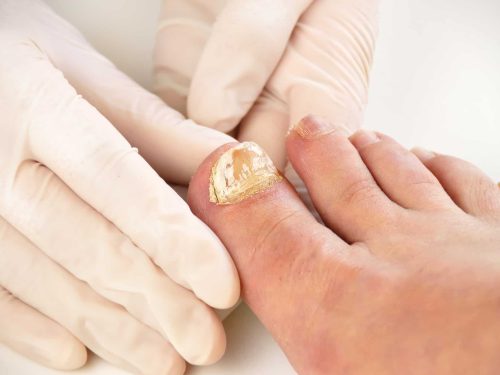 Closeup image of podologist checking the left foot toe nail suffering from fungus infection. horizontal studio picture on white background.