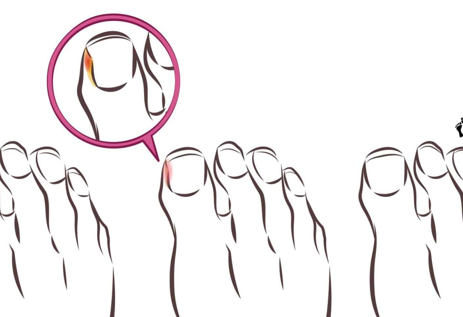 ingrown toenail geotag