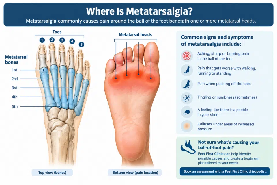 Diagram of the foot showing metatarsalgia, metatarsals, toes and ball of foot pain symptoms. Feet First Clinic, Toronto