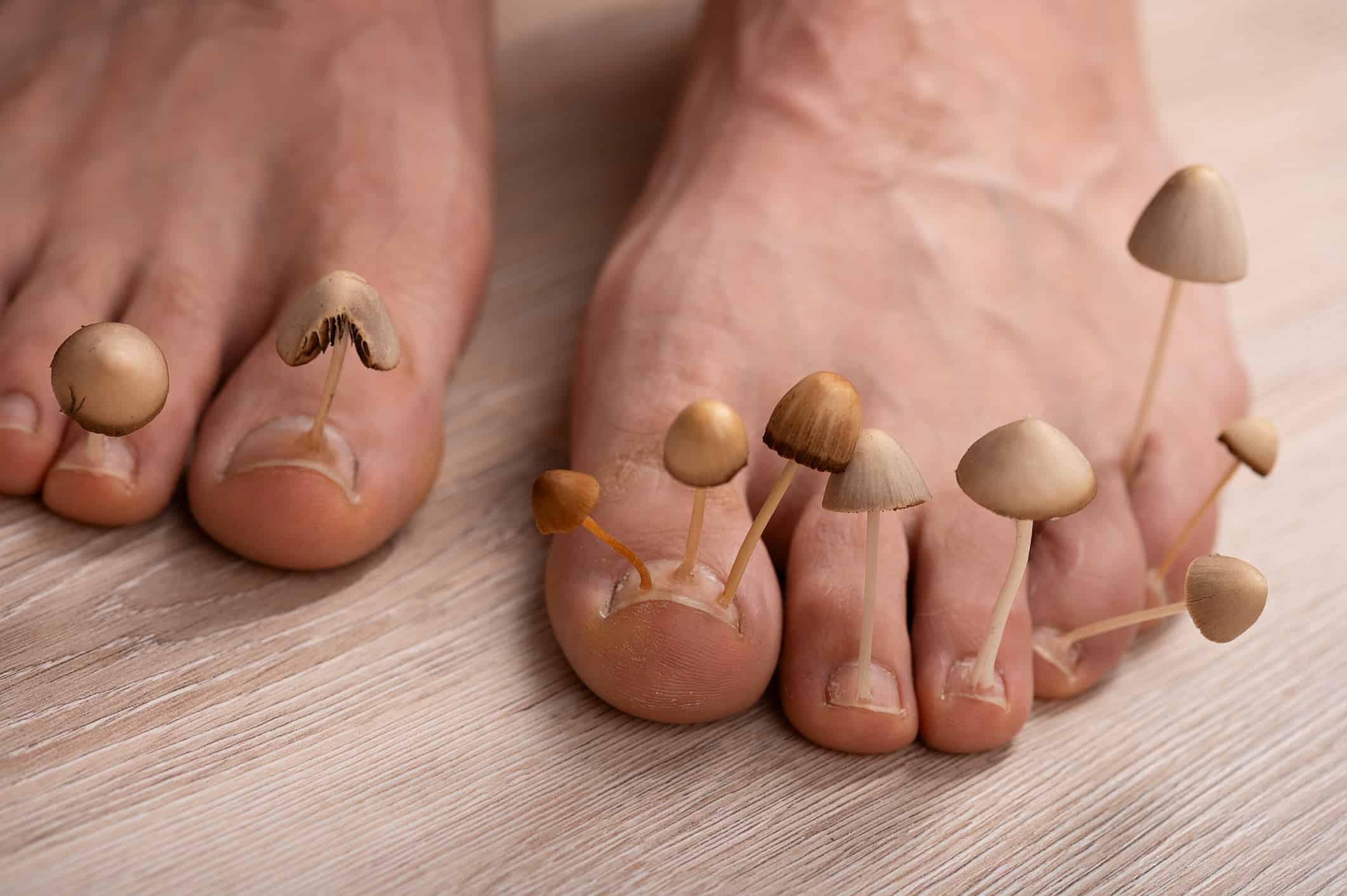 Can You Treat Foot Fungus at Home? (Hint: You Can't) - Feet First Clinic