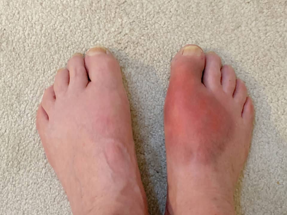 what-is-inflammation-the-good-and-the-bad-feet-first-clinic