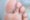 Close up of tinea pedis aka athlete's foot