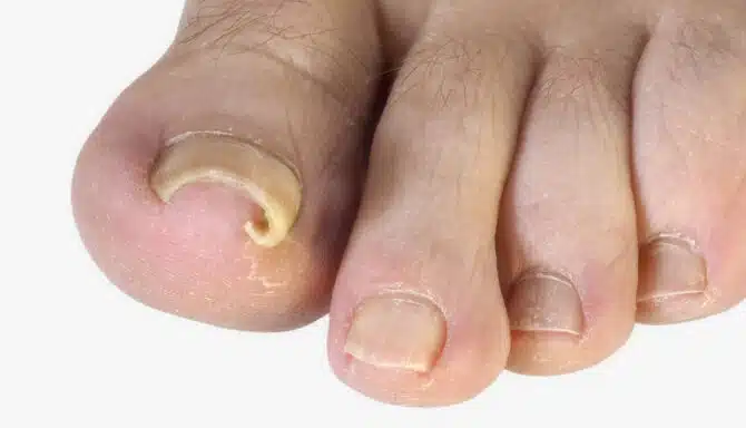 Curly toenail becoming ingrown toenail