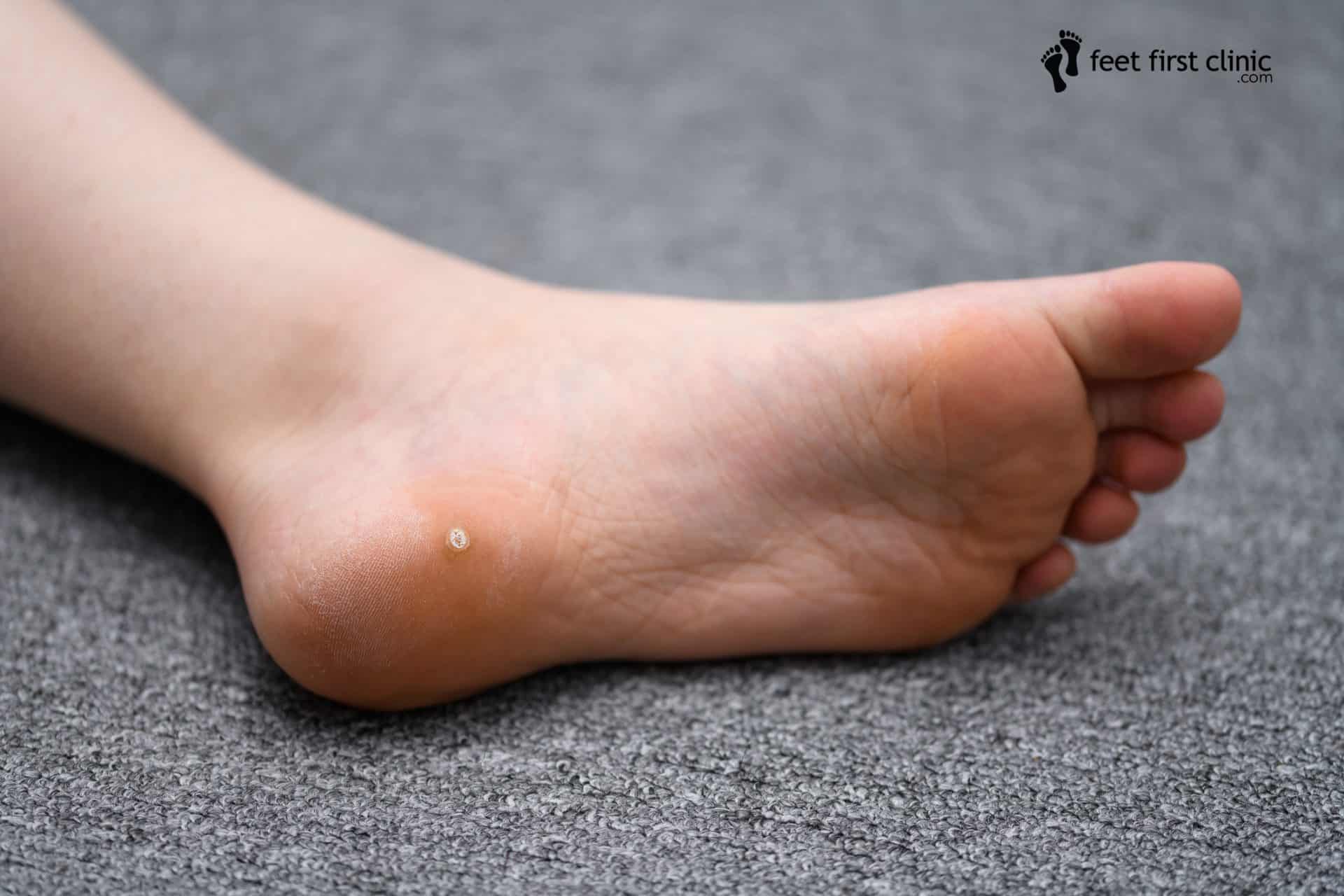 How to Treat Foot Warts