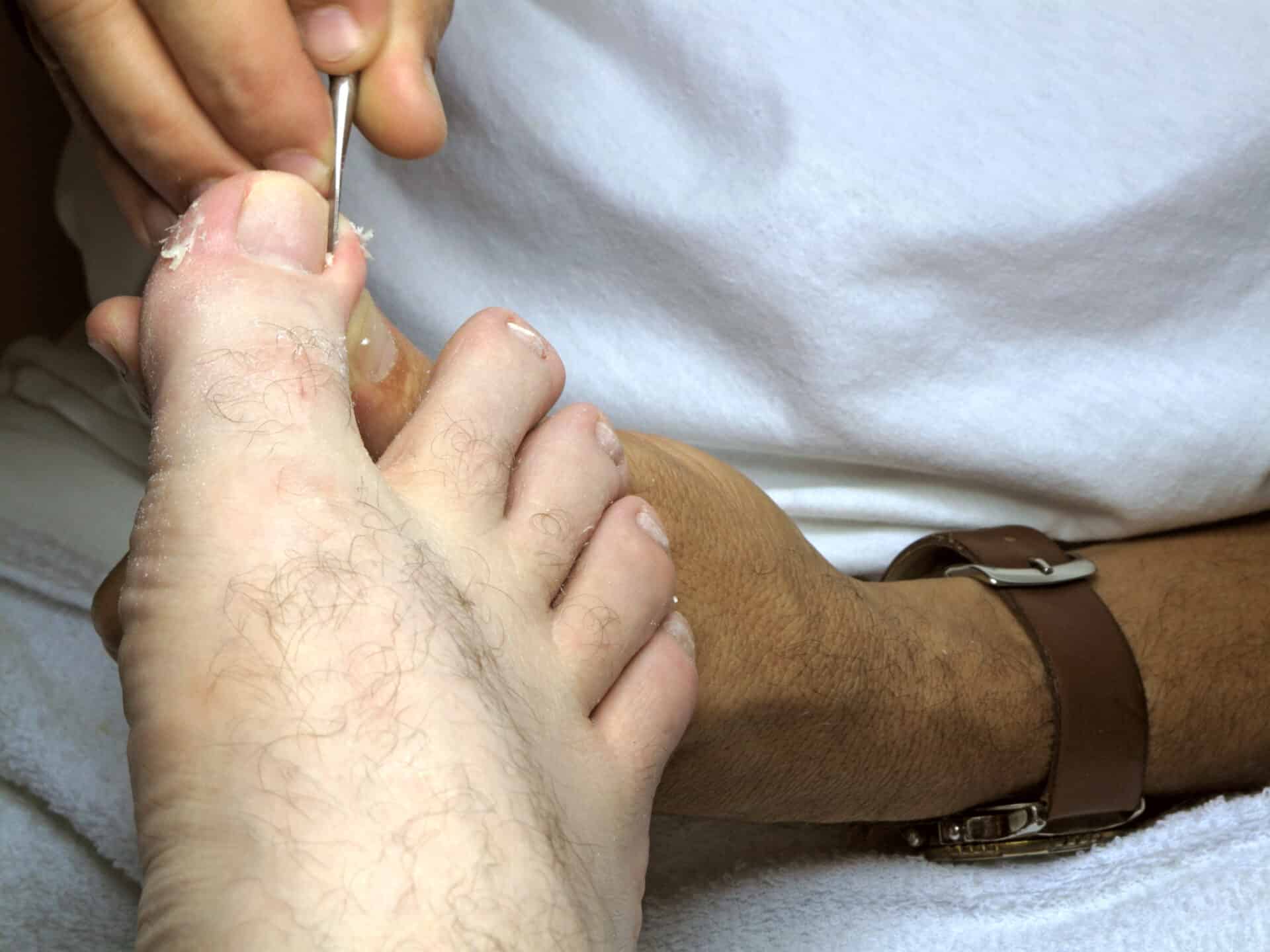 Ingrown toenail treatment