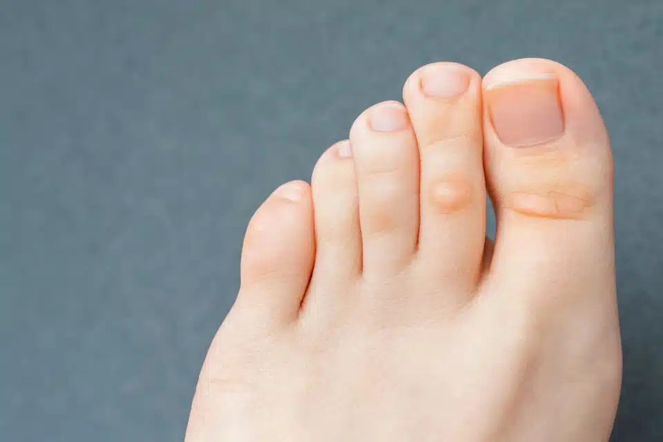 Woman has hard corns and calluses on her toes.