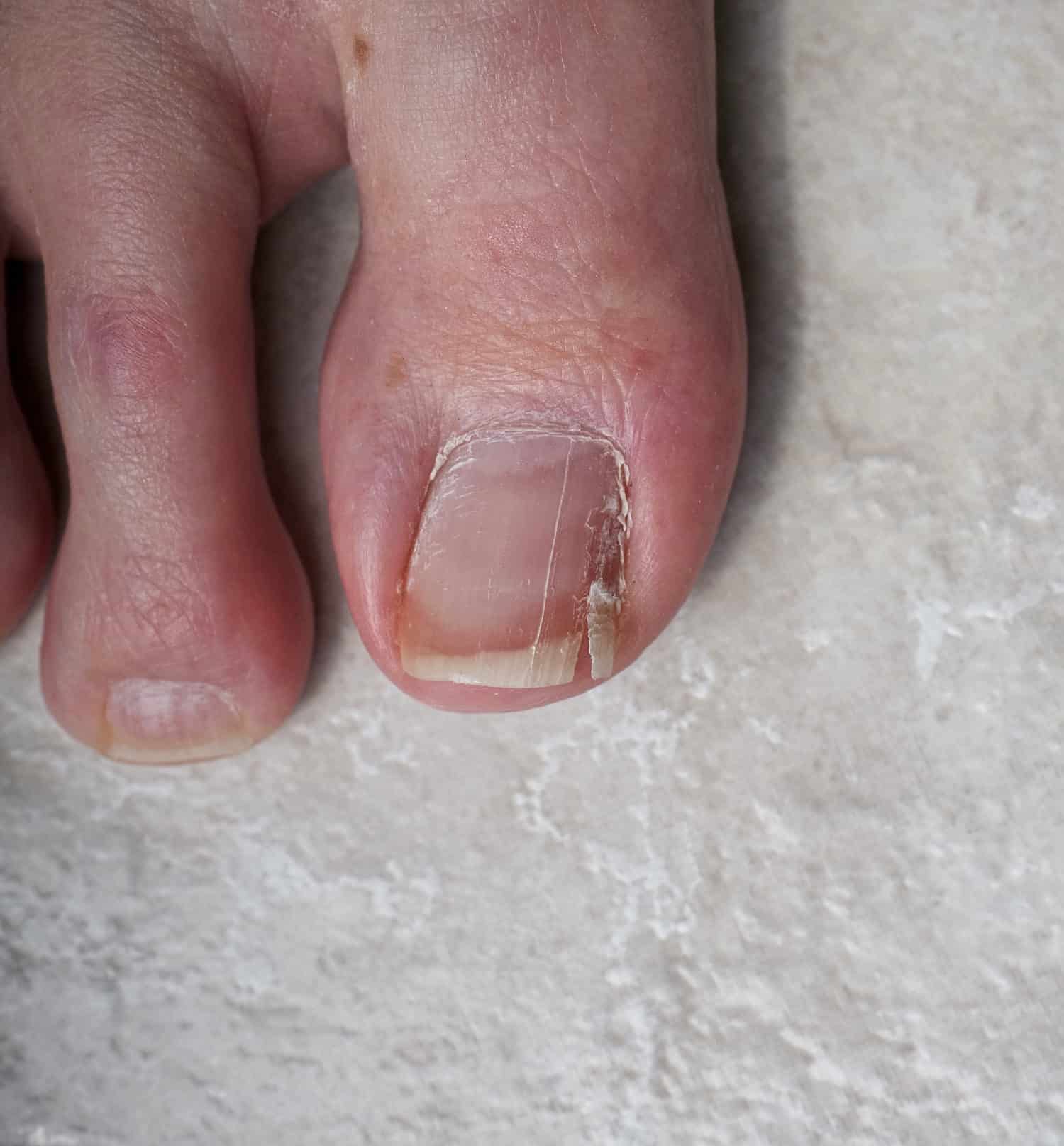 Cracked Toenail Foot Specialist Toronto Feet First Clinic