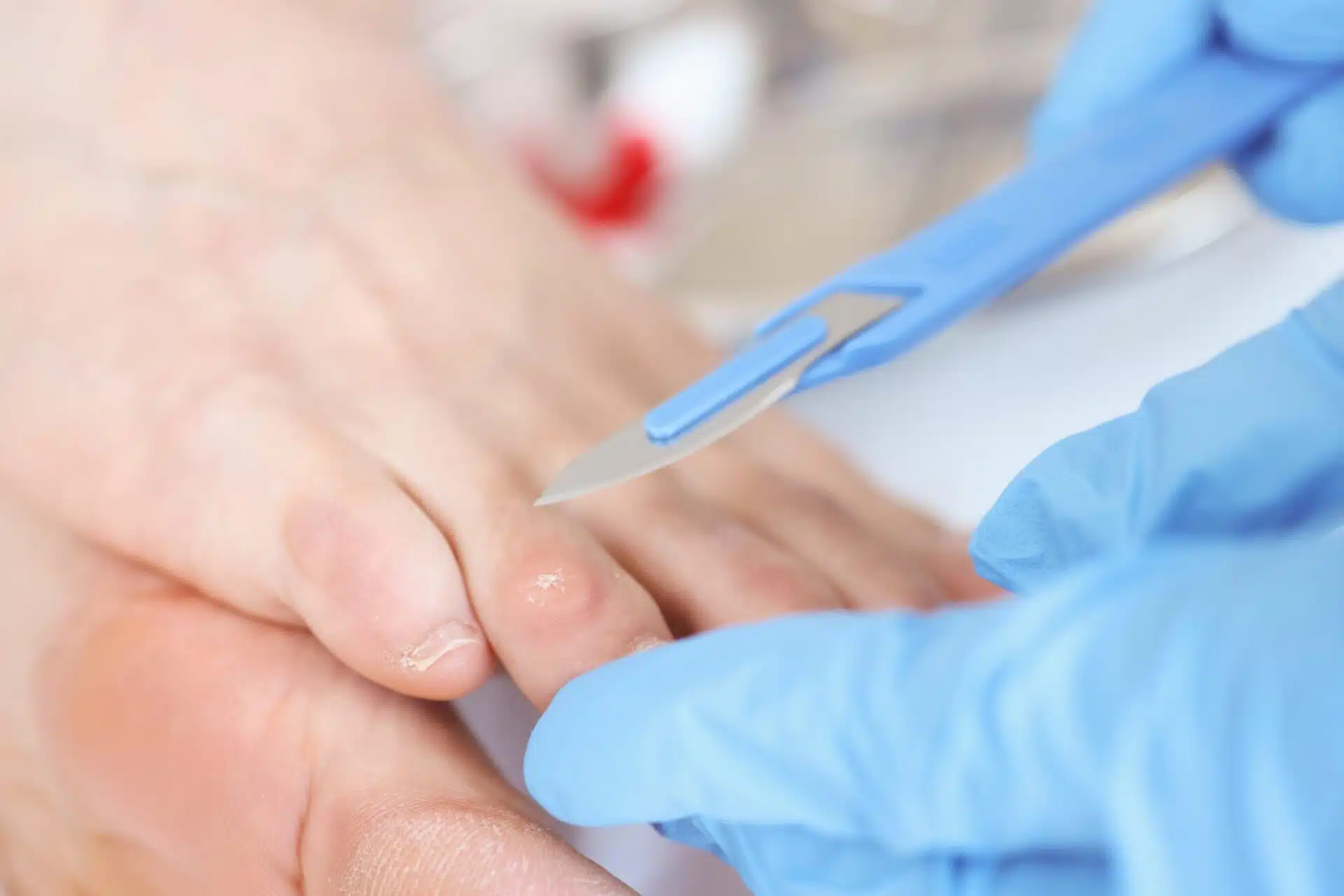 Removing foot corn with a scalpel