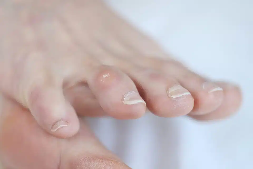 Closeup of dry corn on woman toe. Treatment of corns