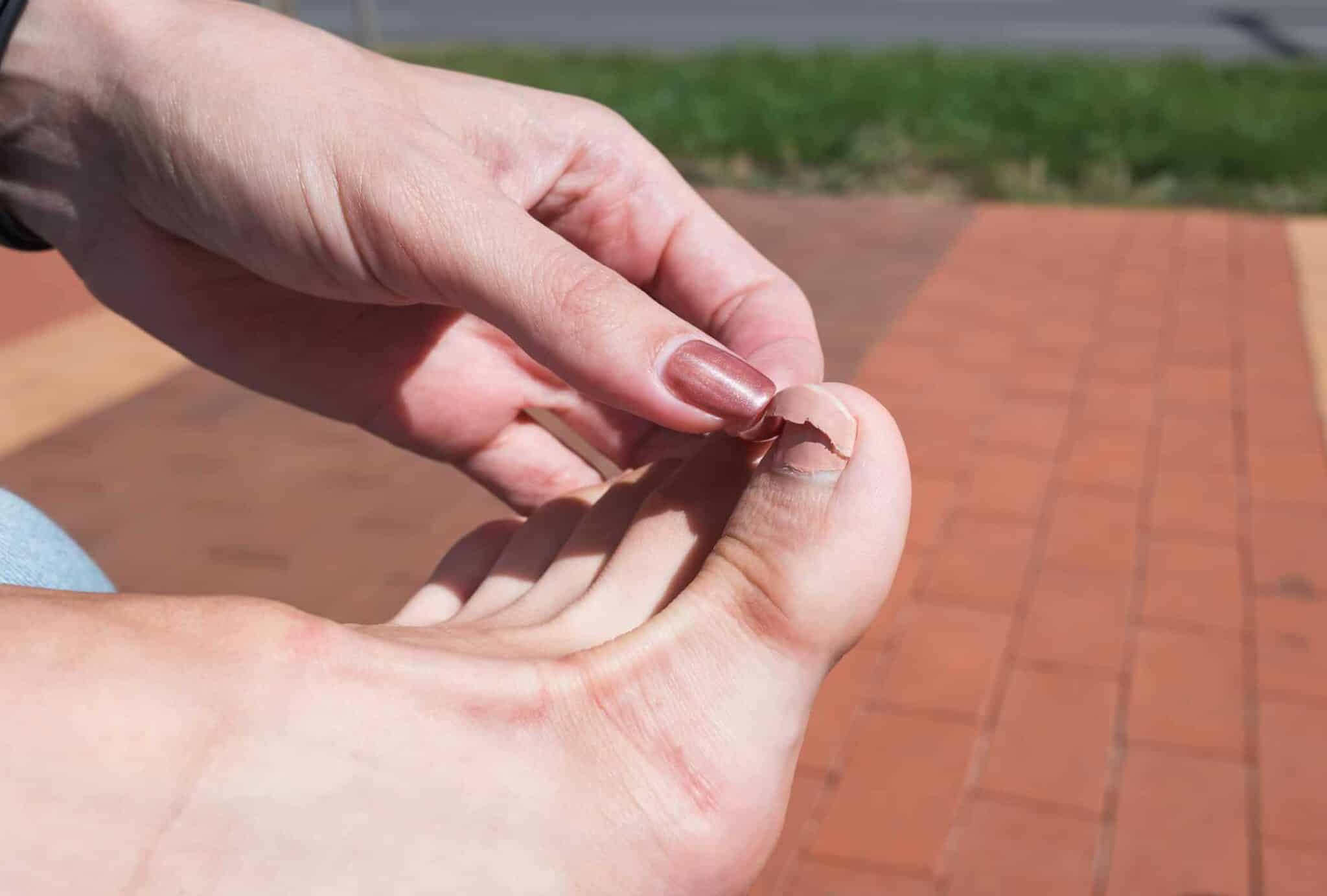 how-to-treat-a-cracked-toenail-feet-first-clinic