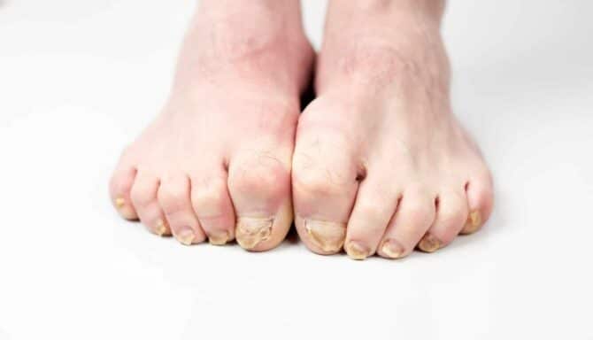 Nail fungus on legs disease. Fungal infection on nails legs, finger with onychomycosis, damage on human legs.