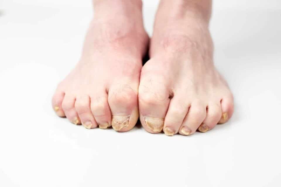 Nail fungus on legs disease. Fungal infection on nails legs, finger with onychomycosis, damage on human legs.