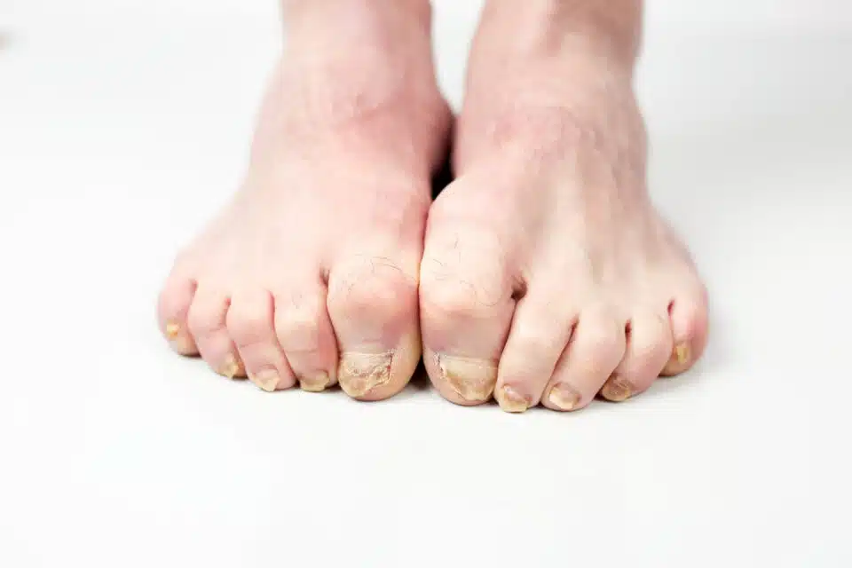 Two feet with fungal infections on toenails on white floor and background