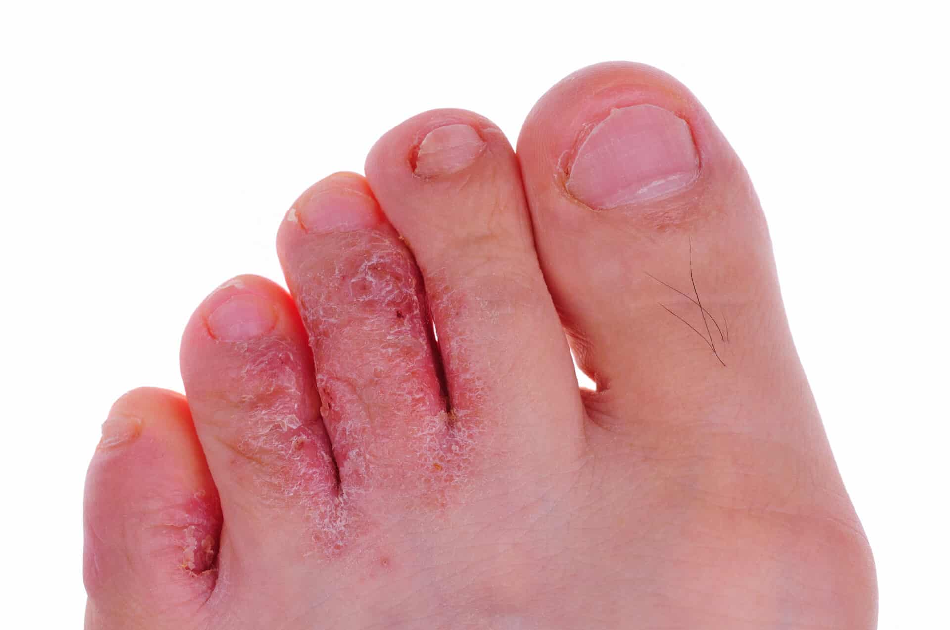Why Do I Have Red Toes? An Overview, Causes, And Prevention Feet