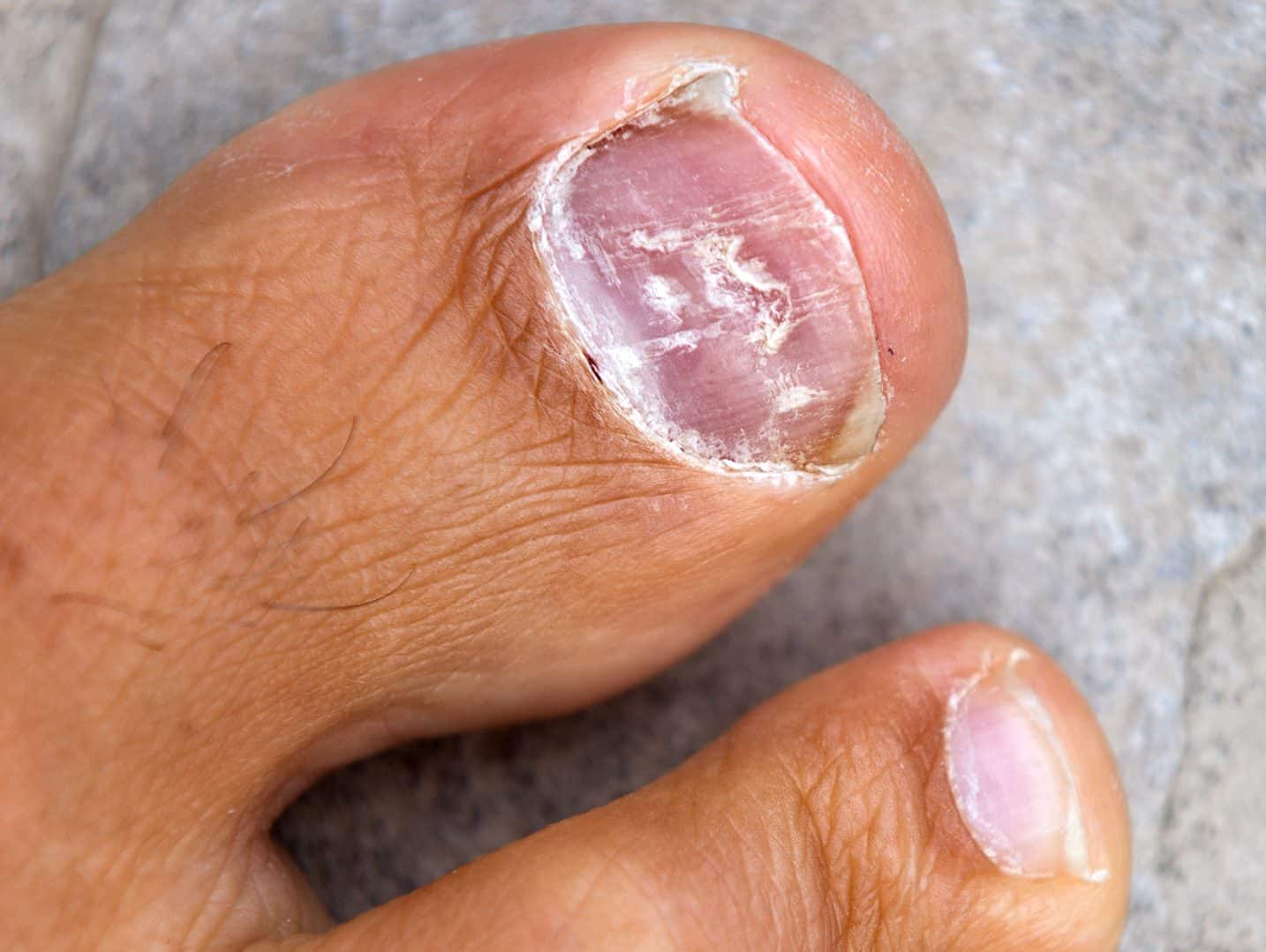 Cracked Toenail | Foot Specialist 