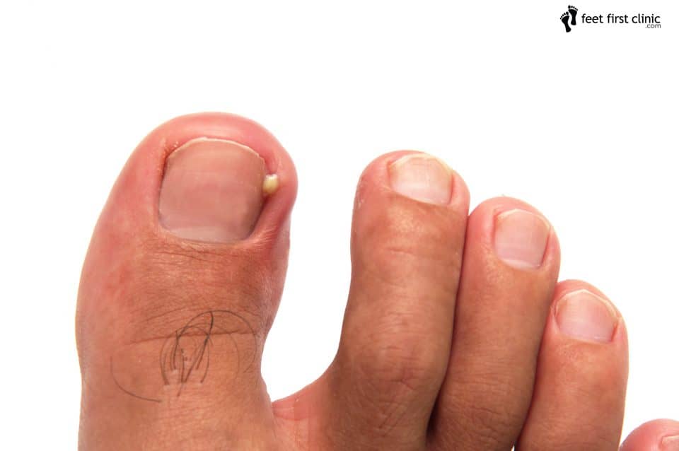 do-i-have-an-ingrown-toenail-feet-first-clinic