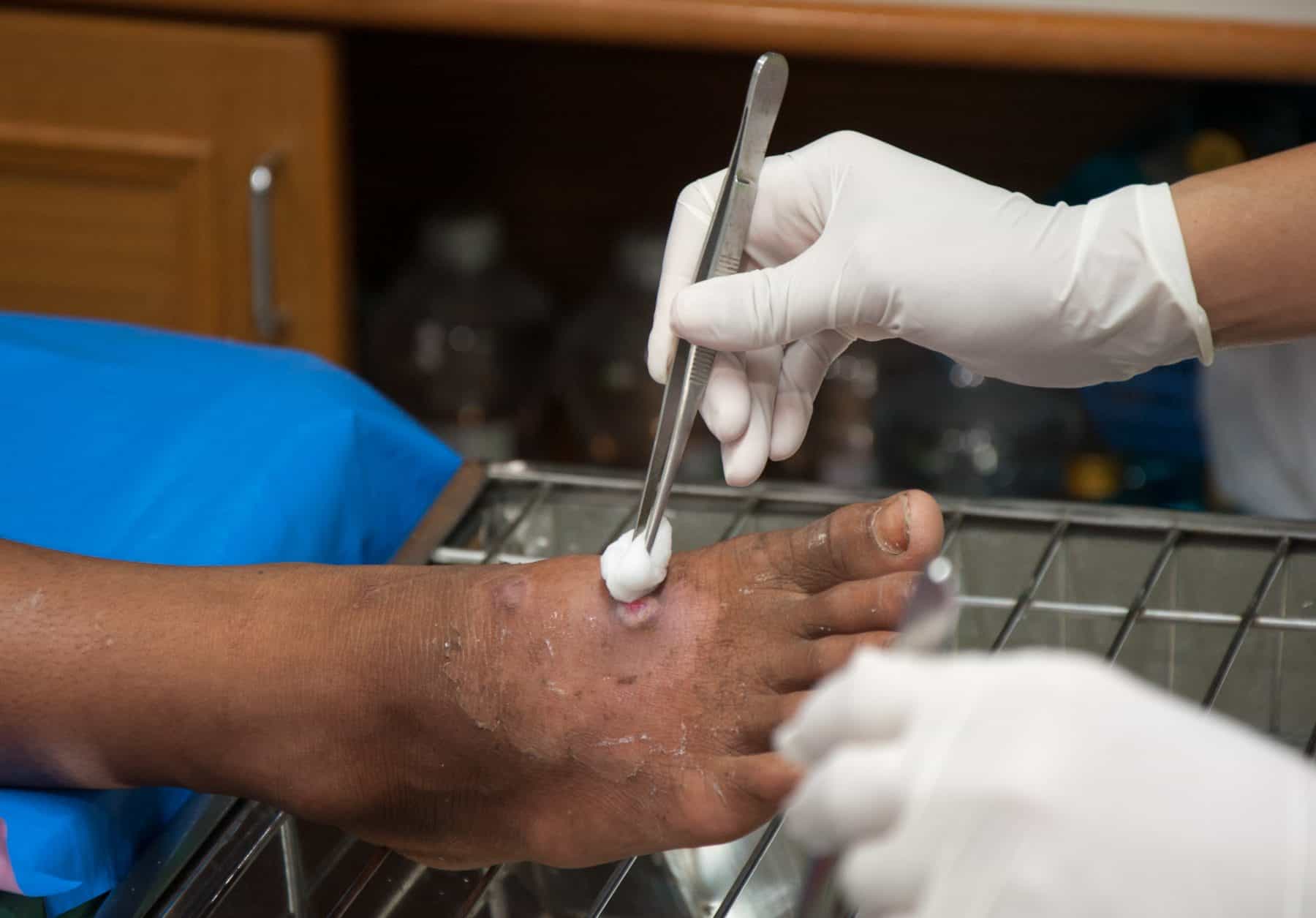 Dressing Patient’s foot With Bandage