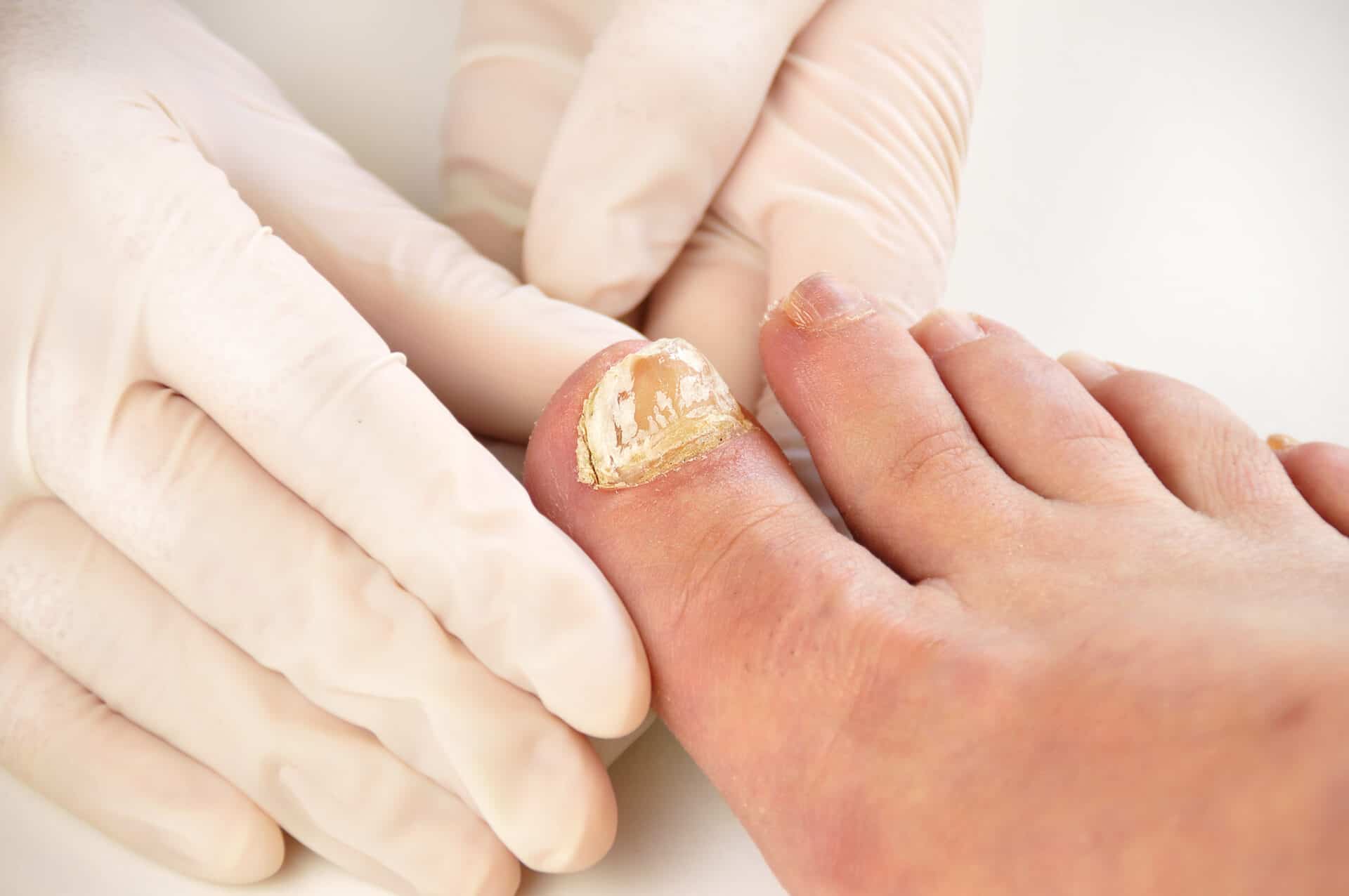 Help! My Toenail Is Falling Off! - Feet First Clinic