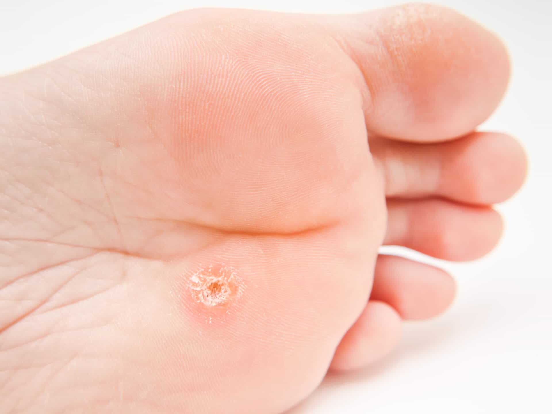 Person with callus located under foot