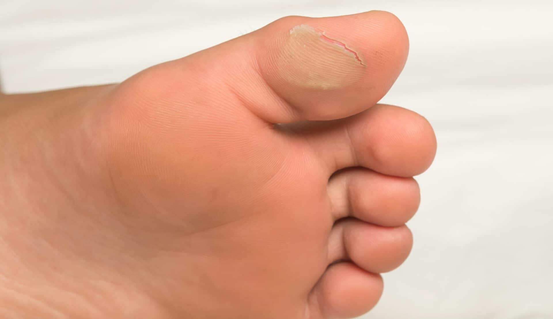 Blisters on the feet
