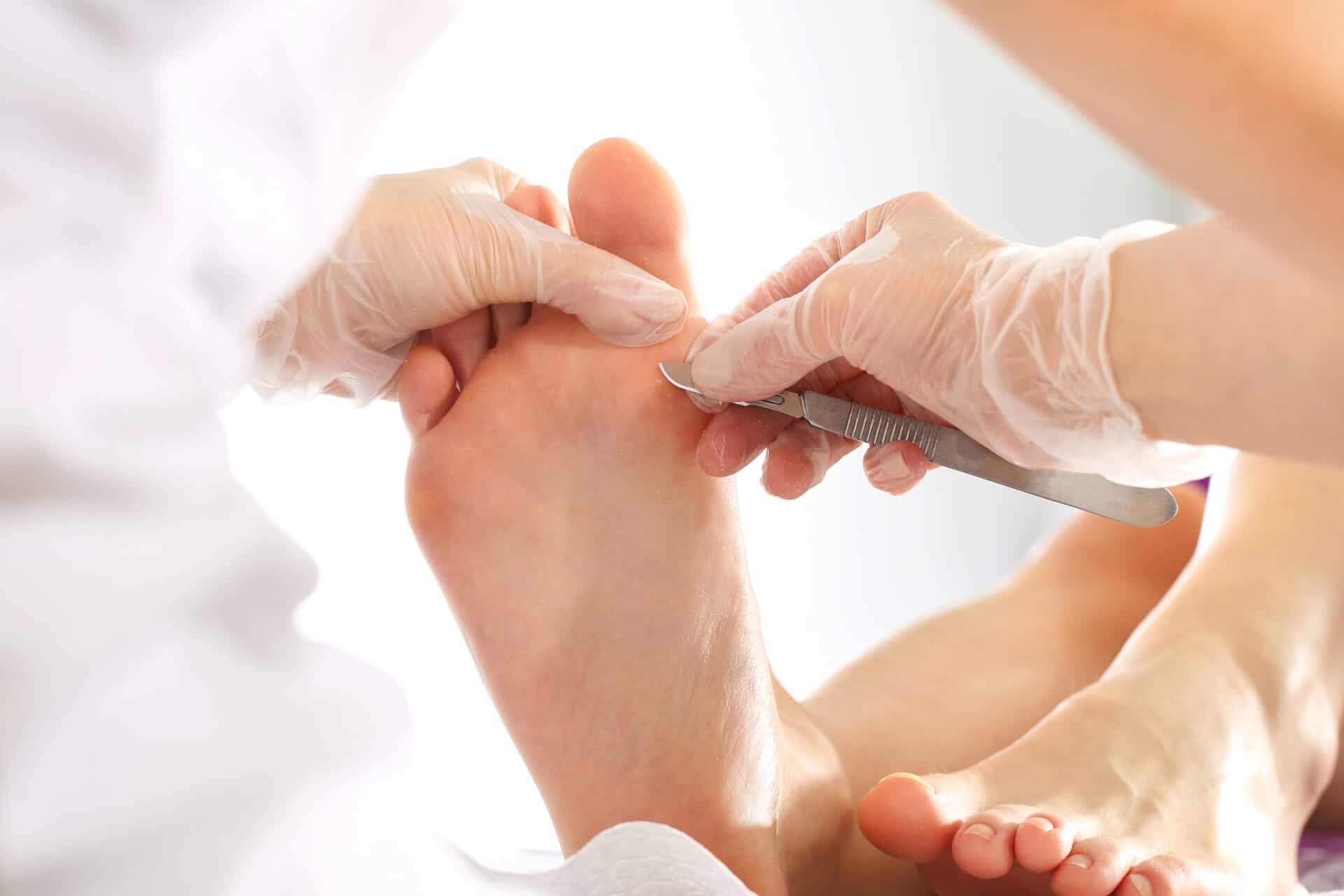 Podology. Removing the prints on the foot.