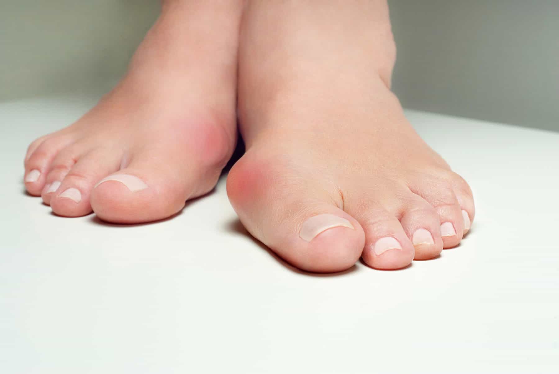 Hallux Rigidus or Bunions What's The Difference? Feet First Clinic
