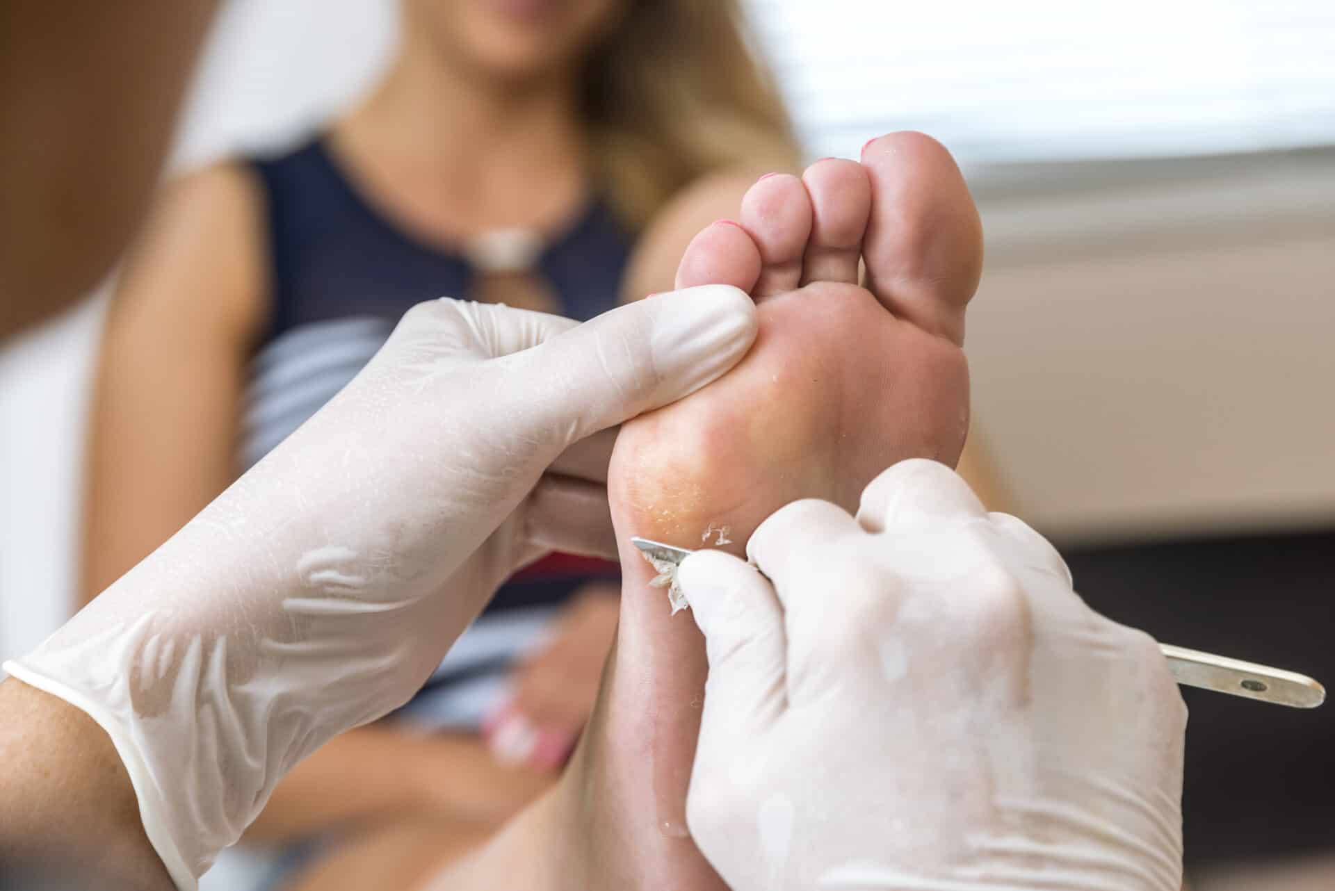 Chiropodist removes skin on a wart