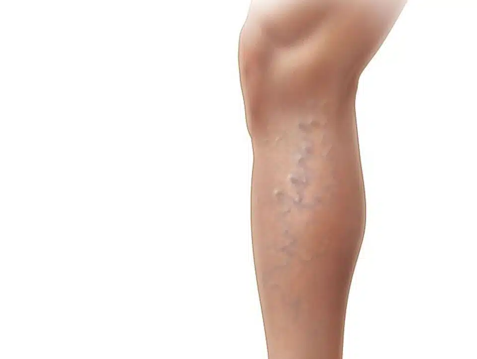Image of varicose veins on side of the leg