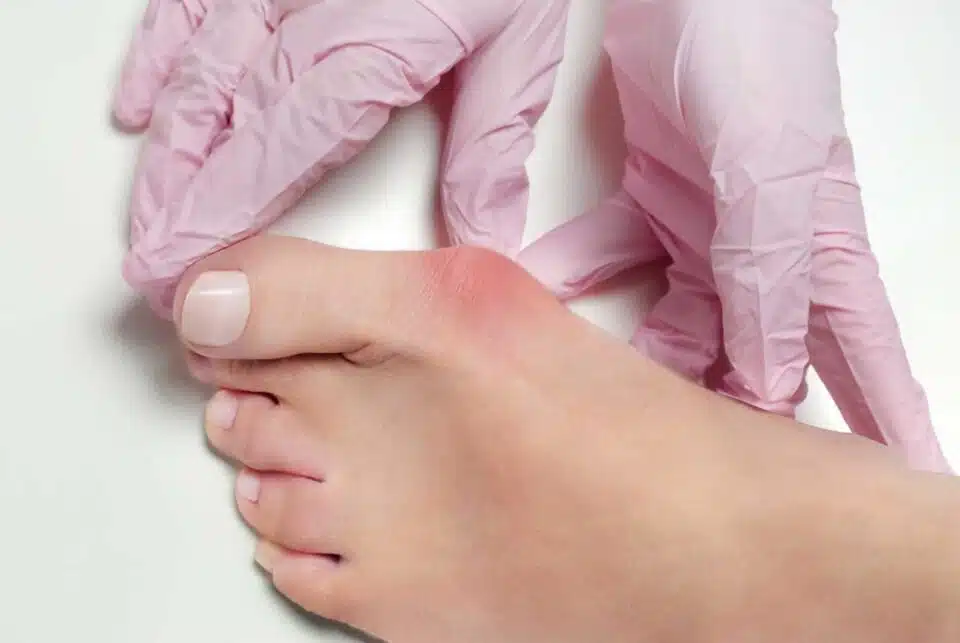 Medical professional assessing and treating a bunion on a patient's foot