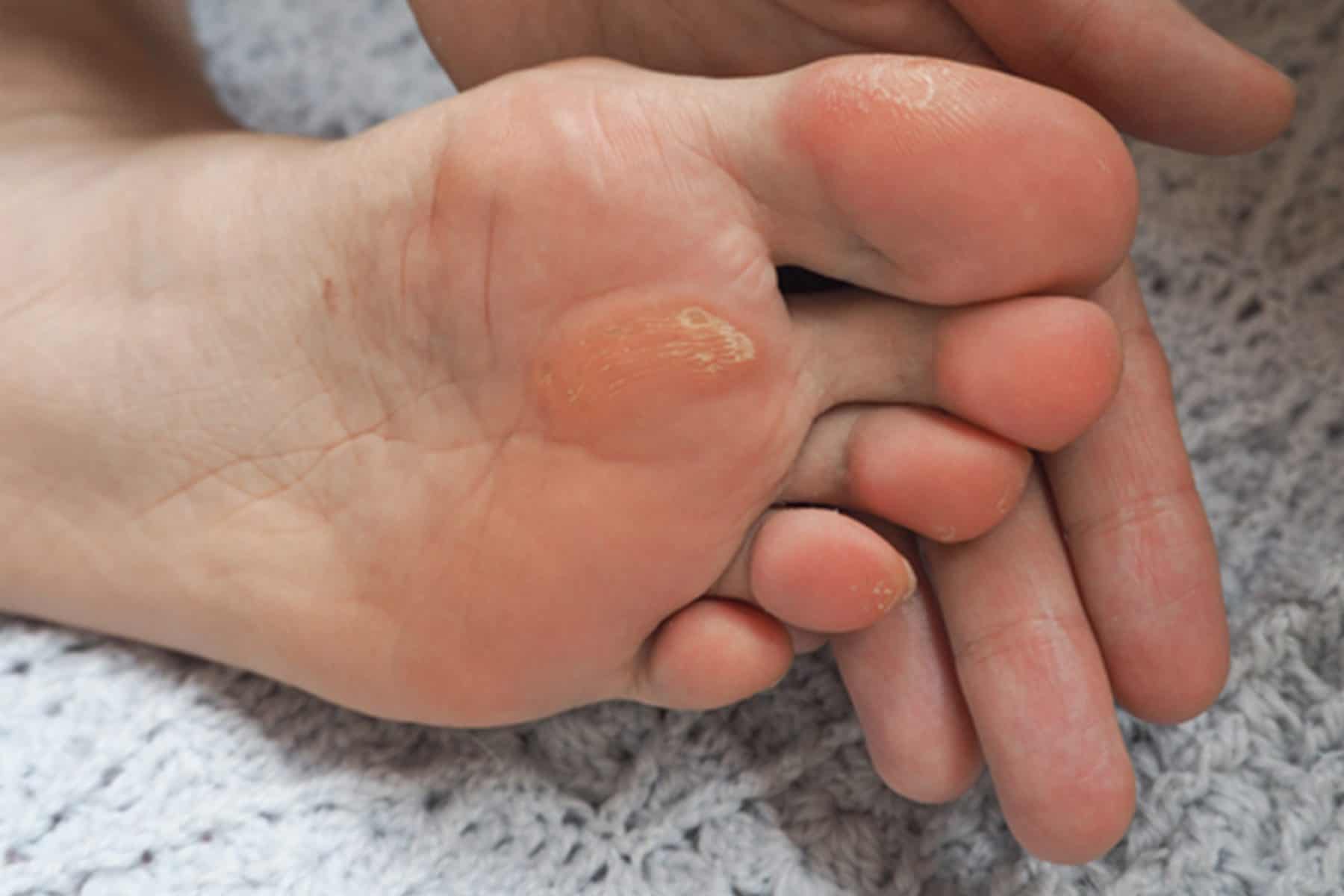 What Causes Calluses On Your Big Toe