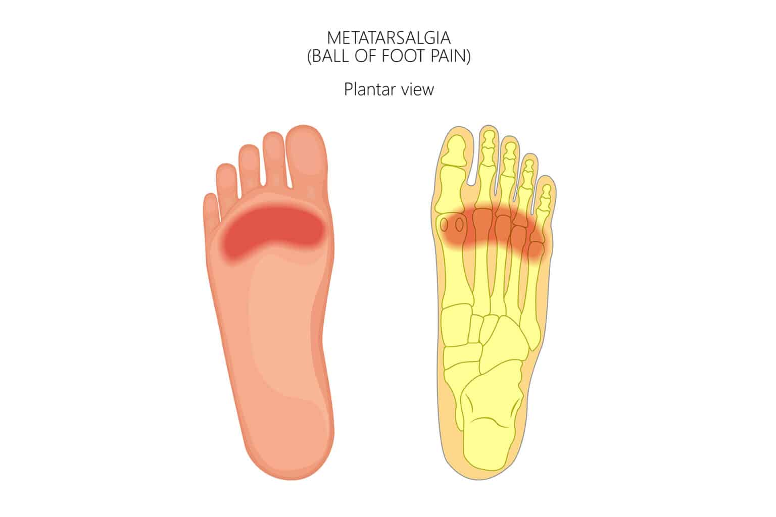 Why Do I Have Pain in The Ball Of My Foot? Feet First Clinic
