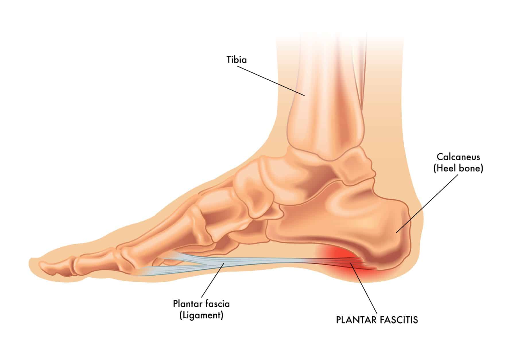 Best Shoes for Plantar Fasciitis Feet First Clinic