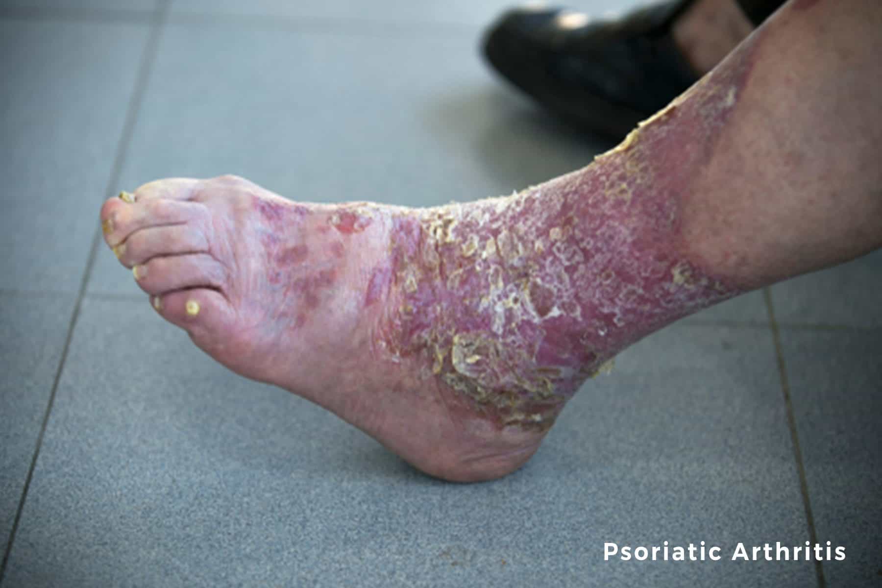 Psoriatic Arthritis | Foot Specialist Toronto | Feet First Clinic