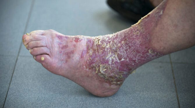 psoriatic arthritis toes