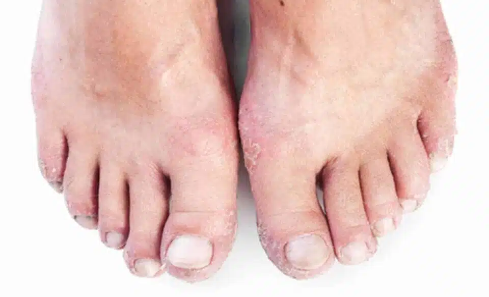 psoriatic arthritis possible cause toenail pitting