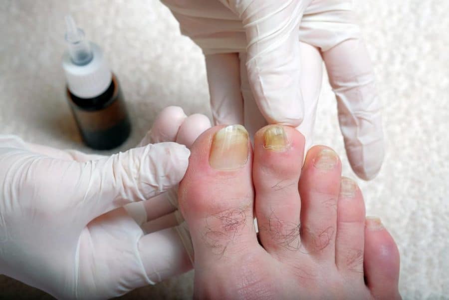 discoloured-toenails-foot-specialist-toronto-feet-first-clinic