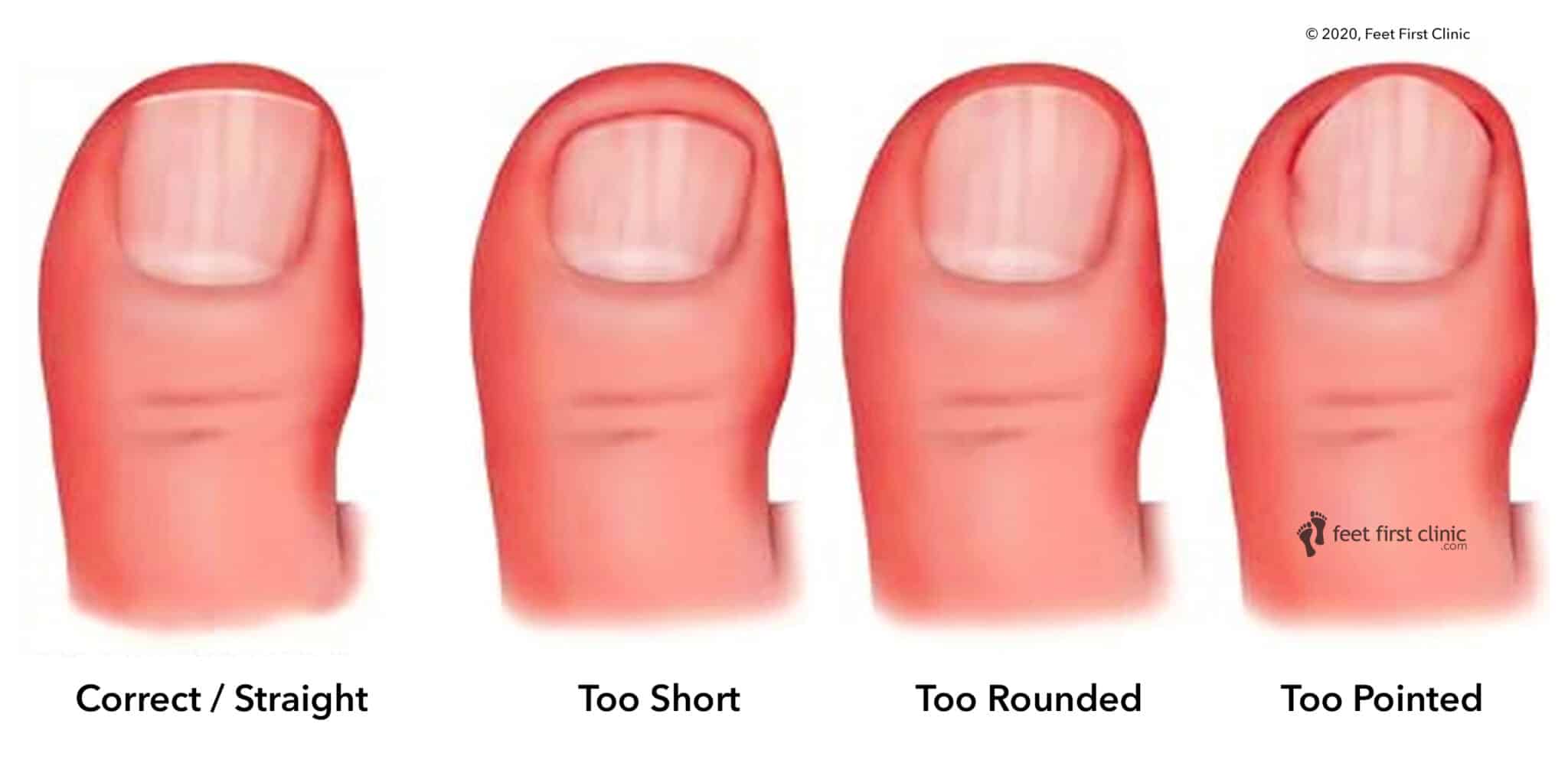 How To Cut Your Toenails Like a Professional - Feet First Clinic