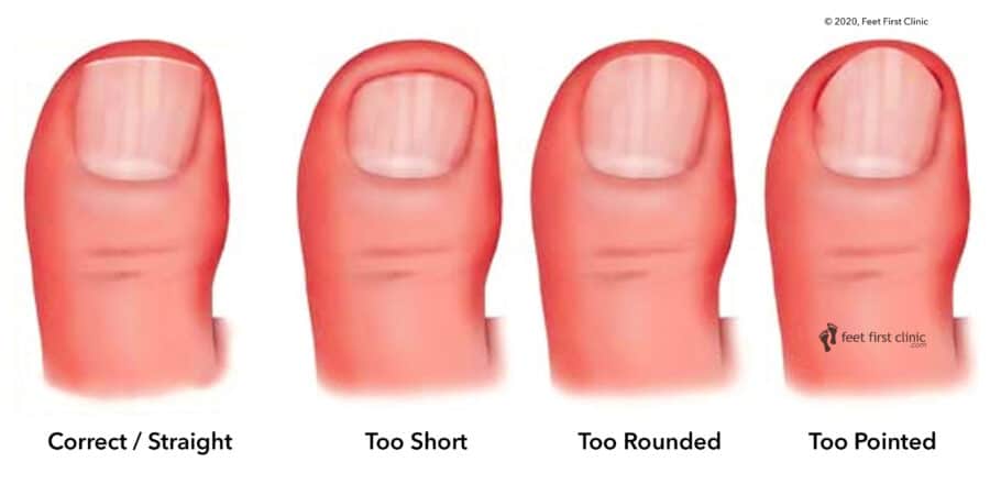 How To Cut Your Toenails Like A Professional Feet First Clinic