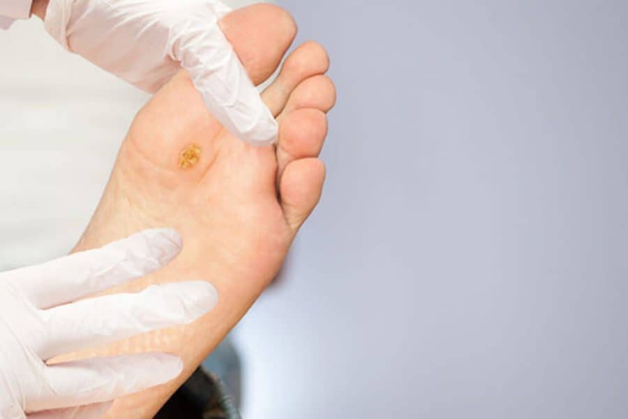 The Best Ways to Deal with a Stubborn Plantar Wart - Feet First Clinic